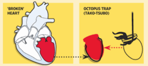 Cartoon-of-Takotsubo-CM